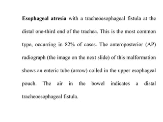 Esophageal atresia with a tracheoesophageal fistula at the
distal one-third end of the trachea. This is the most common

type, occurring in 82% of cases. The anteroposterior (AP)
radiograph (the image on the next slide) of this malformation
shows an enteric tube (arrow) coiled in the upper esophageal
pouch.

The

air

in

tracheoesophageal fistula.

the

bowel

indicates

a

distal

 