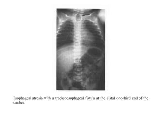Esophageal atresia with a tracheoesophageal fistula at the distal one-third end of the
trachea

 