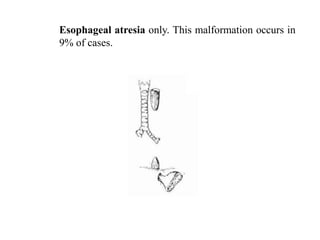 Esophageal atresia only. This malformation occurs in
9% of cases.

 