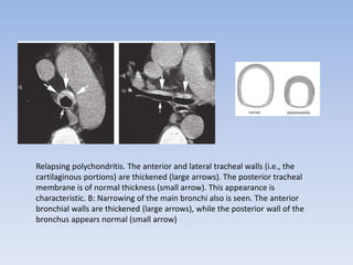 Tracheal pathologies | PPTX