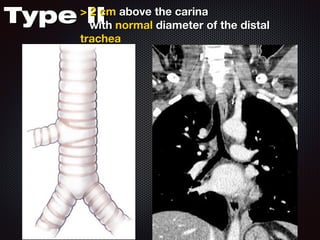 Type II

> 2 cm above the carina
with normal diameter of the distal
trachea

 