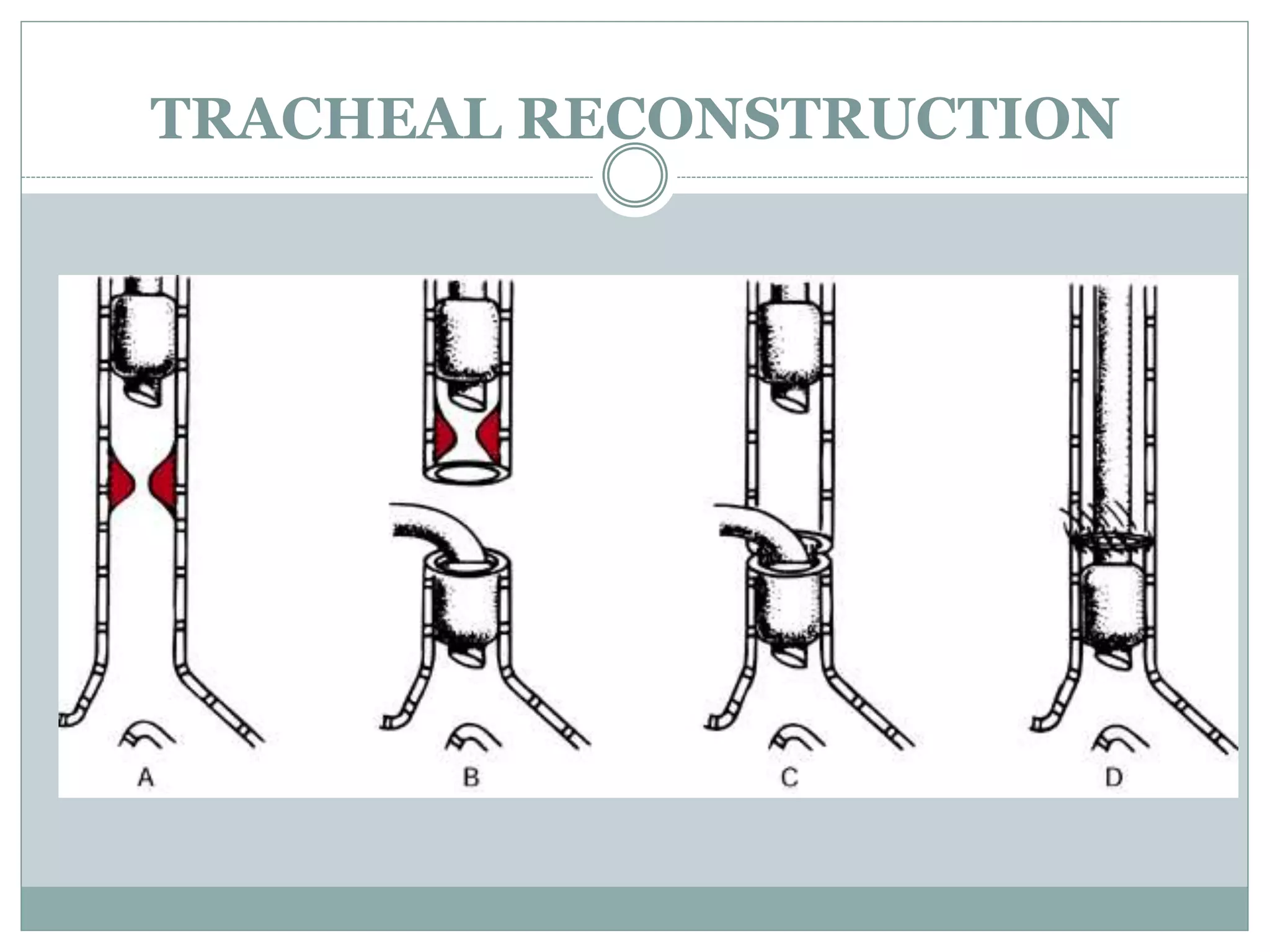 TRACHEAL RECONSTRUCTION
 