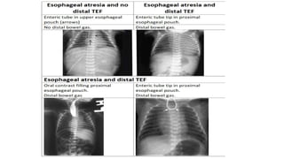 Tef Radiology Tracheo-esophageal fistula radiology power point presentation | PPTX