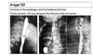Tef Radiology Tracheo-esophageal fistula radiology power point presentation | PPTX