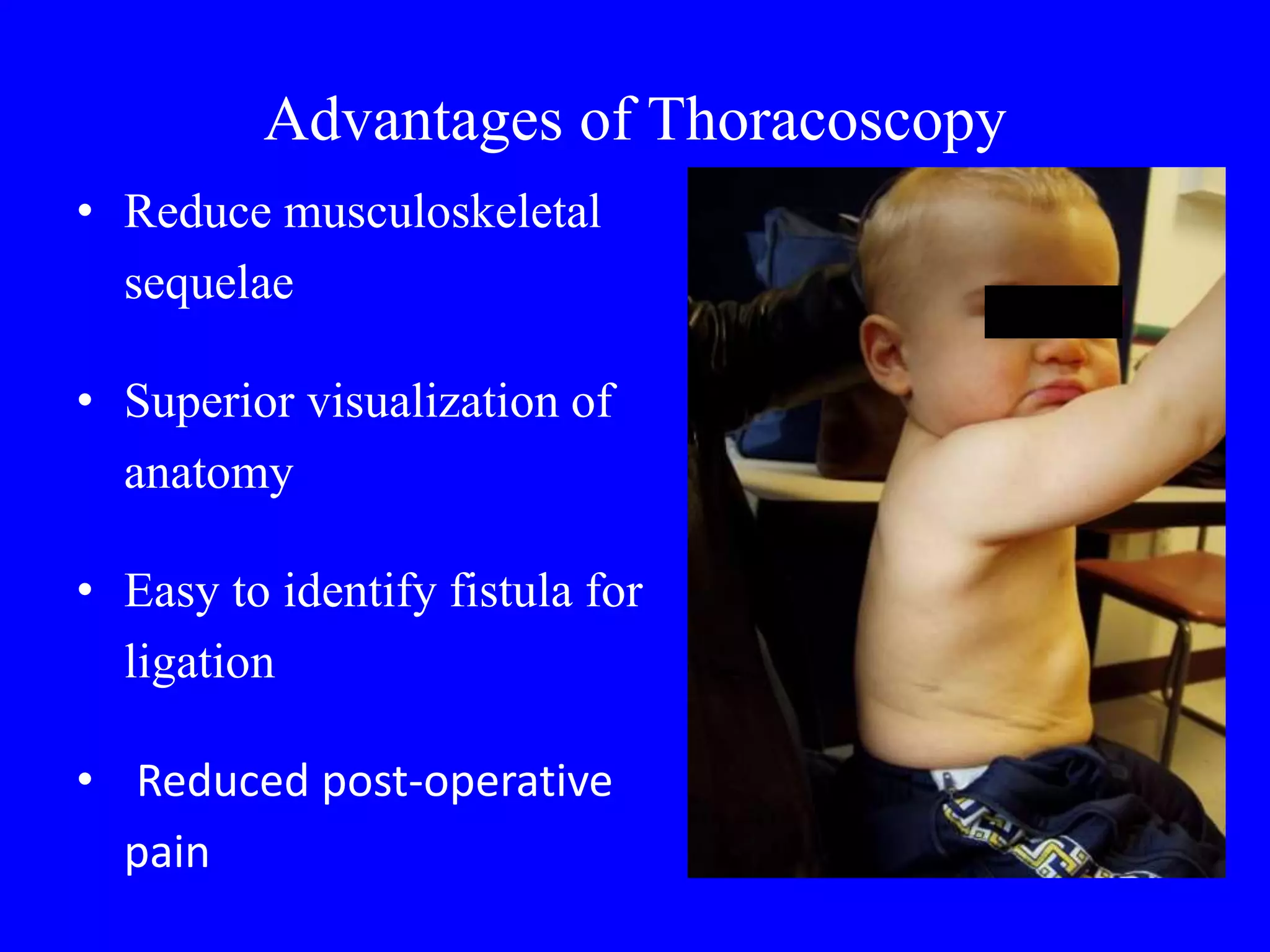 Anesthesia for Tracheoesophageal fistula PPT