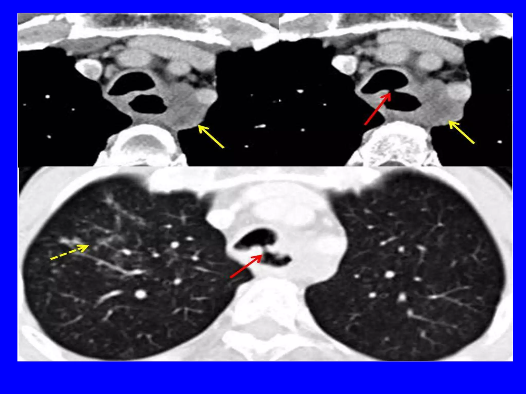 Anesthesia for Tracheoesophageal fistula PPT