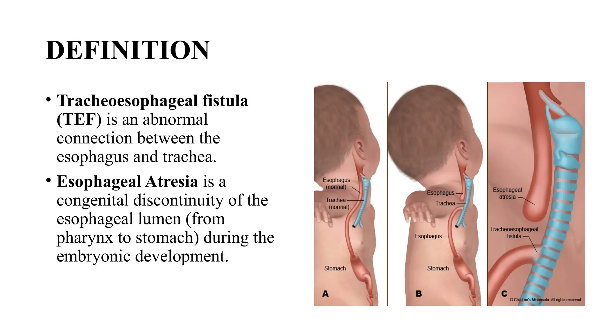 Tef Radiology Tracheoesophageal Fistula (TEF) – A Congenital Malformation of the ...