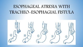 ESOPHAGEAL ATRESIA WITH
TRACHEO-ESOPHAGIAL FISTULA
 