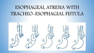 Esophageal atresia