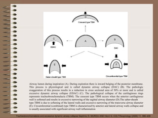 Airway lumen during inspiration (A). During expiration there is inward bulging of the posterior membrane.
This process is physiological and is called dynamic airway collapse (DAC) (B). The pathologic
exaggeration of this process results in a reduction in cross sectional area of 50% or more and is called
excessive dynamic airway collapse (EDAC) (C). The pathological collapse of the cartilaginous rings
represents tracheobronchomalacia (TBM). The crescent type TBM occurs when the anterior cartilaginous
wall is softened and results in excessive narrowing of the sagittal airway diameter (D).The saber-sheath
type TBM is due to softening of the lateral walls and excessive narrowing of the transverse airway diameter
(E). Circumferential (combined) type TBM is characterized by anterior and lateral airway walls collapse and
is usually associated with significant airway wall inflammation
Tracheobronchomalacia and excessive dynamic airway collapse Septimiu D. MURGU AND Henri G. COLTRespirology (2006) 11, 388–406

 