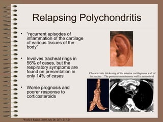 Relapsing Polychondritis
•

“recurrent episodes of
inflammation of the cartilage
of various tissues of the
body”

•

Involves tracheal rings in
56% of cases, but the
respiratory symptoms are
found on presentation in
only 14% of cases

•

Worse prognosis and
poorer response to
corticosteroids

World J Radiol. 2010 July 28; 2(7): 237-24

Characteristic thickening of the anterior cartilaginous wall of
the trachea . The posterior membranous wall is uninvolved

 