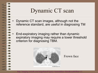 Dynamic CT scan
• Dynamic CT scan images, although not the
reference standard, are useful in diagnosing TM
• End-expiratory imaging rather than dynamic
expiratory imaging may require a lower threshold
criterion for diagnosing TBM.

Frown face

http://imaging.consult.com/imageSearch?query=lumen&thes=false&resultOffset=11

 