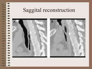 Saggital reconstruction

 