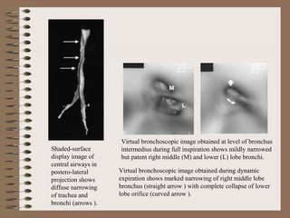 Shaded-surface
display image of
central airways in
postero-lateral
projection shows
diffuse narrowing
of trachea and
bronchi (arrows ).

Virtual bronchoscopic image obtained at level of bronchus
intermedius during full inspiration shows mildly narrowed
but patent right middle (M) and lower (L) lobe bronchi.
Virtual bronchoscopic image obtained during dynamic
expiration shows marked narrowing of right middle lobe
bronchus (straight arrow ) with complete collapse of lower
lobe orifice (curved arrow ).

 