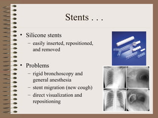 Stents . . .
• Silicone stents
– easily inserted, repositioned,
and removed

• Problems
– rigid bronchoscopy and
general anesthesia
– stent migration (new cough)
– direct visualization and
repositioning

 