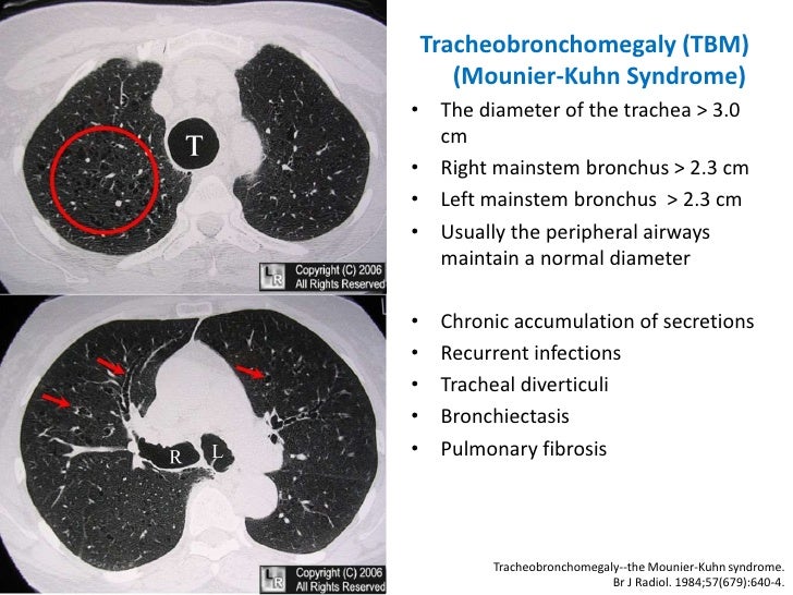 Dynamic Central Airway Obstruction Tracheomalacia, Tracheobronchomal…