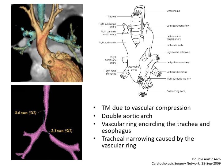 Dynamic Central Airway Obstruction Tracheomalacia, Tracheobronchomal…