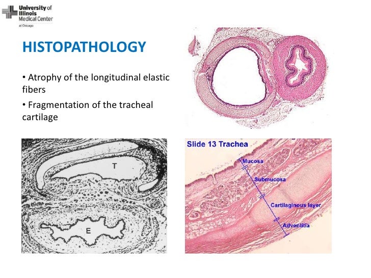Dynamic Central Airway Obstruction Tracheomalacia, Tracheobronchomal…