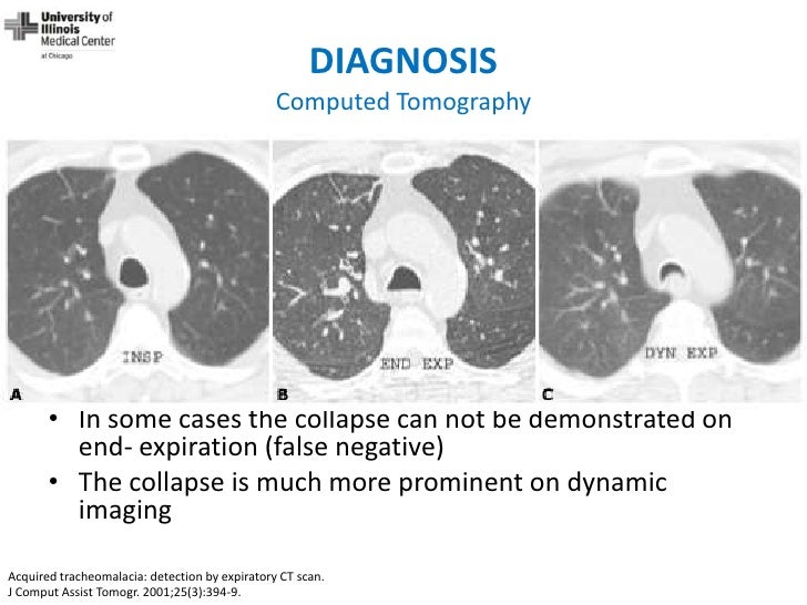 Dynamic Central Airway Obstruction Tracheomalacia, Tracheobronchomal…