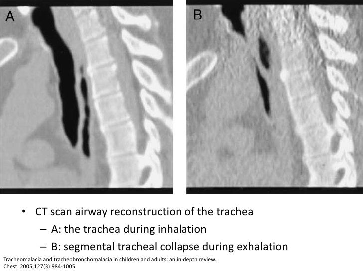 Dynamic Central Airway Obstruction Tracheomalacia, Tracheobronchomal…