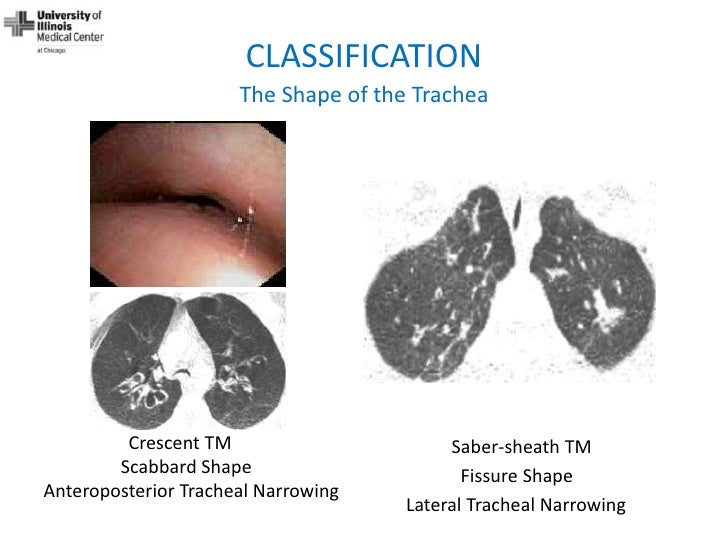 Dynamic Central Airway Obstruction Tracheomalacia, Tracheobronchomal…