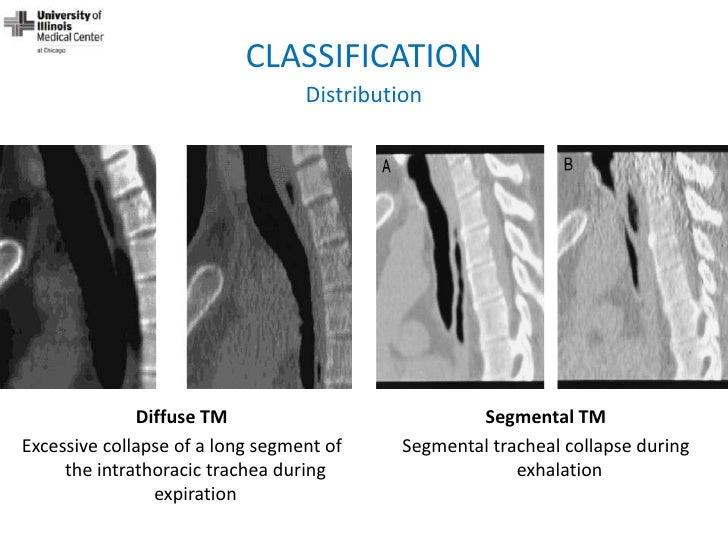 Dynamic Central Airway Obstruction Tracheomalacia, Tracheobronchomal…