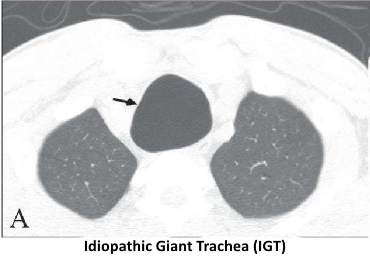 Dynamic Central Airway Obstruction Tracheomalacia, Tracheobronchomal…