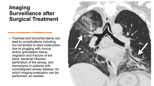 tracheomalcia and edac.pptx | Lung and Respiratory Health | Diseases ...