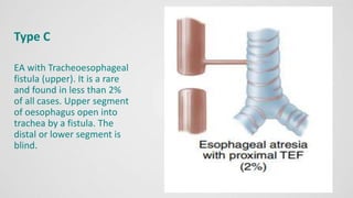 Type C
EA with Tracheoesophageal
fistula (upper). It is a rare
and found in less than 2%
of all cases. Upper segment
of oesophagus open into
trachea by a fistula. The
distal or lower segment is
blind.
 
