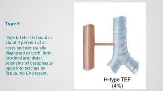 Type E
type E TEF. It is found in
about 4 percent of all
cases and not usually
diagnosed at birth. Both
proximal and distal
segments of oesophagus
open into trachea by
fistula. No EA present.
 