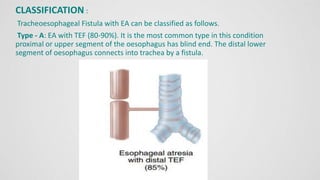 CLASSIFICATION :
Tracheoesophageal Fistula with EA can be classified as follows.
Type - A: EA with TEF (80-90%). It is the most common type in this condition
proximal or upper segment of the oesophagus has blind end. The distal lower
segment of oesophagus connects into trachea by a fistula.
 
