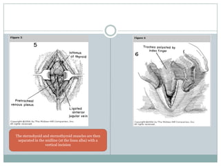 Tracheostomy | PPTX