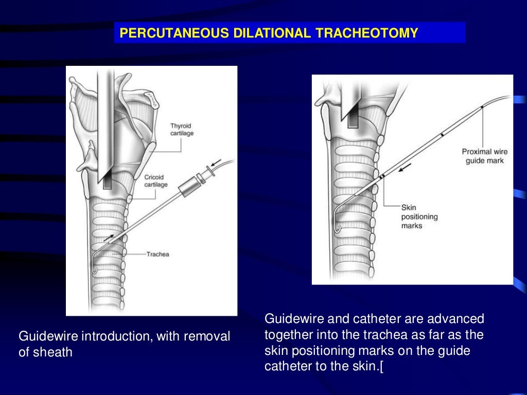 TracheostomyWhen to perform and How to manage?