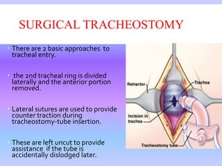 SURGICAL TRACHEOSTOMY
 There are 2 basic approaches to
tracheal entry.
 the 2nd tracheal ring is divided
laterally and the anterior portion
removed.
 Lateral sutures are used to provide
counter traction during
tracheostomy-tube insertion.
 These are left uncut to provide
assistance if the tube is
accidentally dislodged later.
 