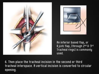 6. Then place the tracheal incision in the second or third
tracheal interspace. A vertical incision is converted to circular
opening.
An inferior based flap, or
Björk flap, (through 2nd & 3rd
Tracheal rings) is commonly
used.
 
