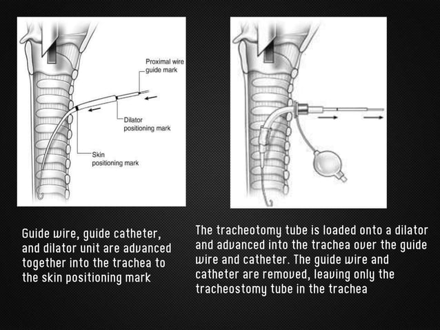 Tracheostomy | PPTX | Thyroid Disorders | Endocrine and Metabolic Diseases