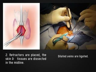 2. Retractors are placed, the
skin & tissues are dissected
in the midline.
Dilated veins are ligated.
 