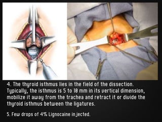 4. The thyroid isthmus lies in the field of the dissection.
Typically, the isthmus is 5 to 10 mm in its vertical dimension,
mobilize it away from the trachea and retract it or divide the
thyroid isthmus between the ligatures.
5. Few drops of 4% Lignocaine injected.
 
