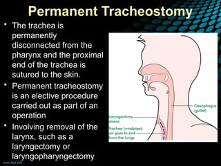 Permanent Tracheostomy
• The trachea is
permanently
disconnected from the
pharynx and the proximal
end of the trachea is
sutured to the skin.
• Permanent tracheostomy
is an elective procedure
carried out as part of an
operation
• Involving removal of the
larynx, such as a
laryngectomy or
laryngopharyngectomy
 