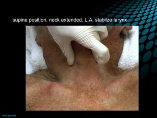 supine position, neck extended, L.A, stabilze larynx
 