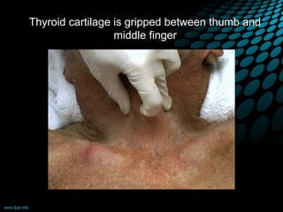 Thyroid cartilage is gripped between thumb and
middle finger
 