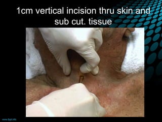 1cm vertical incision thru skin and
sub cut. tissue
 