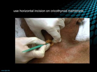 use horizontal incision on cricothyroid membrane
 