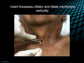 insert trousseau dilator and dilate membrane
vertically
 