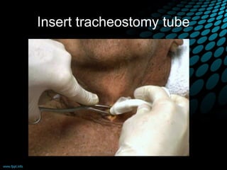 Insert tracheostomy tube
 
