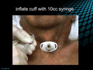 inflate cuff with 10cc syringe
 