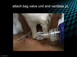 attach bag valve unit and ventilate pt.
 