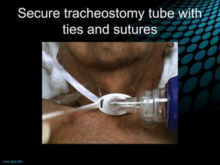 Secure tracheostomy tube with
ties and sutures
 