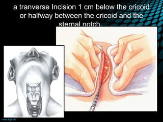 a tranverse Incision 1 cm below the cricoid
or halfway between the cricoid and the
sternal notch.
 