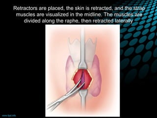 Retractors are placed, the skin is retracted, and the strap
muscles are visualized in the midline. The muscles are
divided along the raphe, then retracted laterally
 